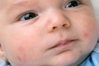 RHCG A visual guide to rashes and other skin conditions in babies and